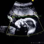 태아 기형 오진율 0% 도전! 바이오틱스 AI(Biotics AI), 혁신적 초음파 소프트웨어 FDA 승인 쾌거